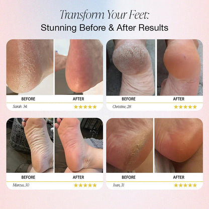 Exclusive Offer🎉 - Electric Feet Callus Remover